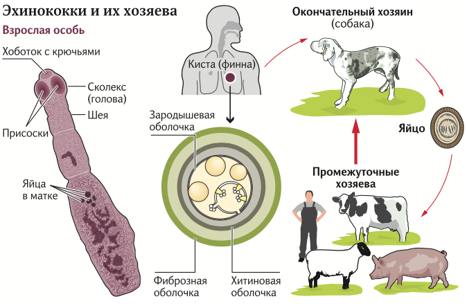 МРТ диагностика эхинококковой кисты